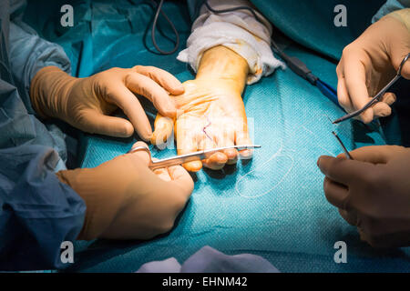 Der Dupuytren'schen Kontraktur Handchirurgie. Stockfoto