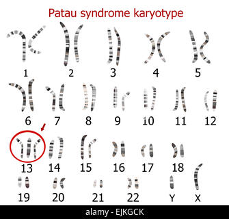 Pätau-Syndrom Karyotyp (Trisomie 13) Stockfoto