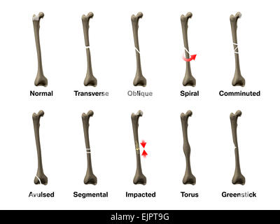 Alle Arten von Knochenbrüchen Stockfoto