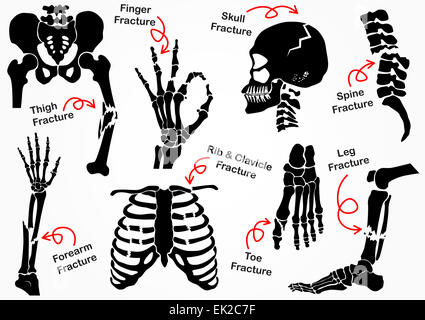 Knochenbruch Gruppensymbol (Becken, Hüfte, Oberschenkel (Femur), Hand, Handgelenk, Finger, Schädel, Gesicht, Wirbel, Arm, Ellbogen, Thorax Stockfoto