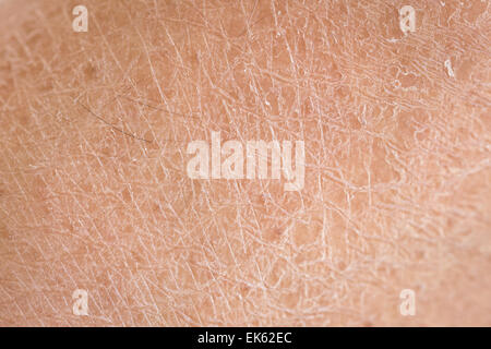 Makro-trockene Haut (Ichthyosis)-detail Stockfoto