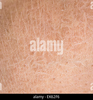 Makro-trockene Haut (Ichthyosis)-detail Stockfoto