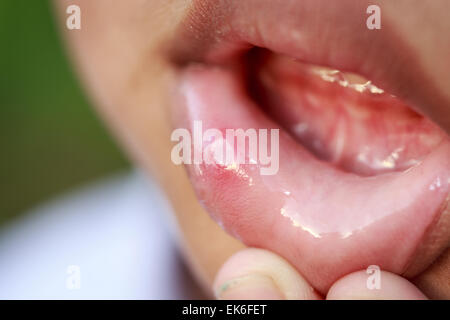 Kinder mit Aphten auf Lippe hautnah Stockfoto