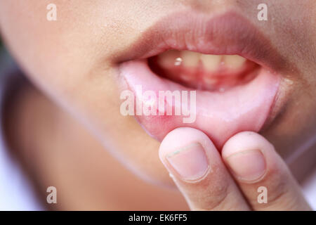 Kinder mit Aphten auf Lippe hautnah Stockfoto