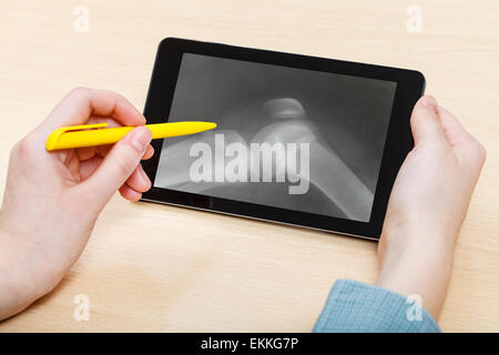 Student analysiert Röntgenbild der menschlichen Kniegelenk auf dem Bildschirm auf TabletPC Stockfoto