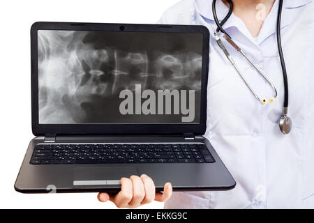 Krankenschwester hält Computer Laptop mit Röntgenbild der menschlichen Wirbelsäule auf Bildschirm isoliert auf weißem Hintergrund Stockfoto