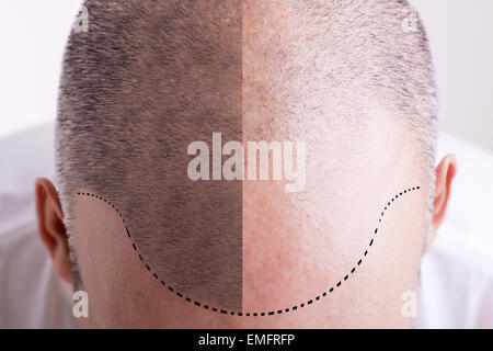 Draufsicht auf ein Männer Kopf mit einem zurückweichenden Haaransatz - vor und nach Stockfoto