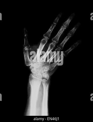 XRAY durch Erwachsene Hand und Handgelenk mit Radius und Ulna Knochen diagnostische Behandlung Finger Daumen Stockfoto