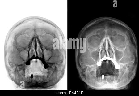 Röntgen-Computertomographie gescannte Bild alte Frau Kopf mit Migräne Stockfoto