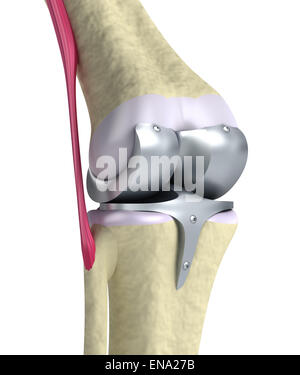 Knie und Titan Scharniergelenk. Isoliert auf weiss Stockfoto