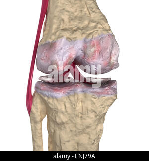 Arthrose: Kniegelenk mit Bänder und Knorpel Stockfoto