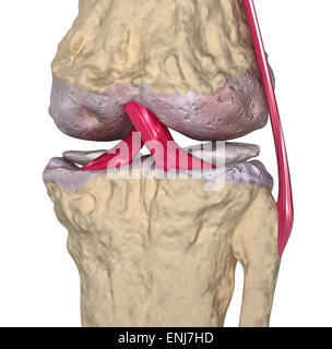 Arthrose: Kniegelenk mit Bänder und Knorpel Stockfoto