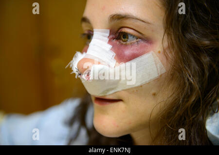 Junge Frau mit Bandagen auf Gesicht während der Genesung von einer Nasenkorrektur (Rhinoplastik) in einem Krankenhausbett Stockfoto