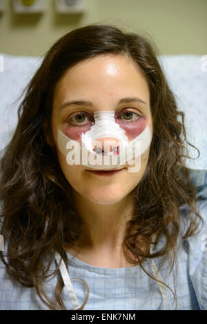 Junge Frau mit Bandagen auf Gesicht während der Genesung von einer Nasenkorrektur (Rhinoplastik) in einem Krankenhausbett Stockfoto