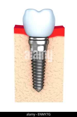 Zahnimplantat im Kieferknochen Stockfoto