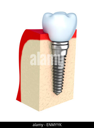 Zahnimplantat im Kieferknochen Stockfoto