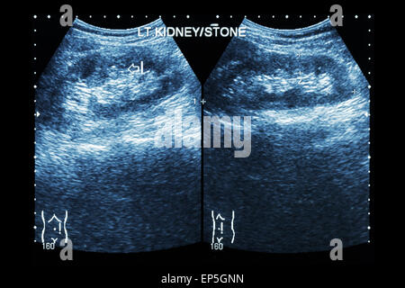 Sonographie der Niere: verließ Show Nierenstein (2 Bilder vergleichen) Stockfoto