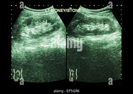 Sonographie der Niere: verließ Show Nierenstein (2 Bilder vergleichen) Stockfoto