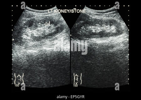 Sonographie der Niere: verließ Show Nierenstein (2 Bilder vergleichen) Stockfoto