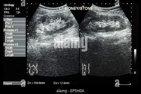 Sonographie der Niere: verließ Show Nierenstein (2 Bilder vergleichen) Stockfoto