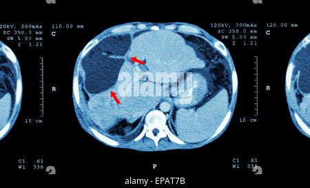 CT-Scan des oberen Abdomen: zeigen abnorme Masse in der Leber (Leberkrebs) Stockfoto