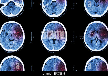 Ischämischen Schlaganfall: (CT des Gehirns zeigen Hirninfarkt im linken Frontallappen - temporal - Parietallappen) (Nervensystem Zeitmessung Stockfoto