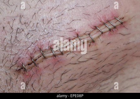 Postoperative Leistenbruch chirurgischen Inzision Stockfoto