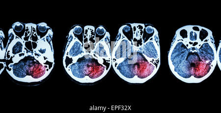Schlaganfall (CT-Scan des Gehirns) und Basis des Schädels und Schlaganfall Stockfoto