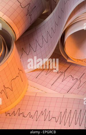 Ekg Spuren Von Herzrhythmusstorungen Wie Kammerflimmern Vf Und Ventrikularer Tachykardie Vt Stockfotografie Alamy