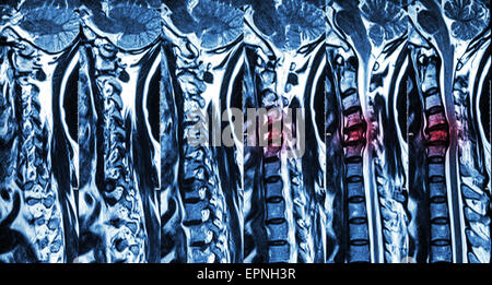 Zervikale Spondylose mit Bandscheibenvorfall (MRT der Halswirbelsäule: Show zervikale Spondylose mit Bandscheibenvorfall komprimieren Spin Stockfoto