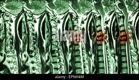 Zervikale Spondylose mit Bandscheibenvorfall (MRT der Halswirbelsäule: Show zervikale Spondylose mit Bandscheibenvorfall komprimieren Spin Stockfoto