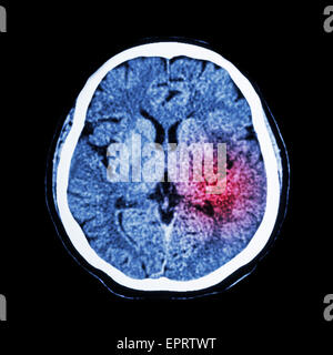 CT-Scan des Gehirns zeigen ischämischen Schlaganfall oder hämorrhagischer Schlaganfall Stockfoto