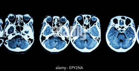 CT-Scan des Gehirns und der Schädelbasis (Show Struktur des Auges, Siebbein Nebenhöhlen, Kleinhirn, Großhirn) Stockfoto