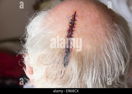Applying teilweise glatzköpfigen Mann mit einer Kopfverletzung mit zwölf Stichen. Stockfoto