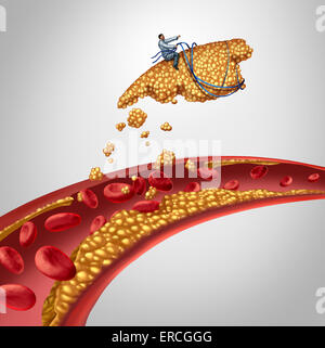 Arterielle Plaque Chirurgie als Arzt eine Arterie-Konzept als Chirurg Cholesterin-Ablagerungen in einer verstopften menschliche Vene zu entfernen, wie ein Symbol der Atherosklerose medizinische Behandlung öffnen Wege für Blut-Kreislauf-Gesundheit verstopft reinigen. Stockfoto