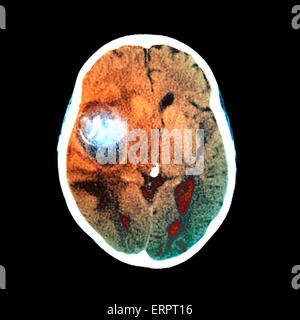 Farbige Computertomographie (CT)-Scan des Gehirns eine 58-jährige Patientin, die ein Aneurysma (links Mitte) wurde in die mittlere zerebrale Arterie berechnet. Ein Aneurysma ist eine blutgefüllte Dilatation in ein Blutgefäß. Es wird verursacht durch eine Schwächung der Gefäßwand, wh Stockfoto