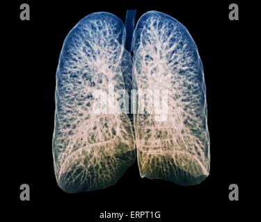 Farbige 3D Computertomographie (CT) Untersuchung der gesunden Lunge eines 30 Jahre alten Patienten. Stockfoto