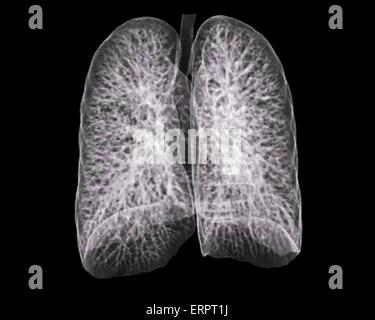 3D Computertomographie (CT) Untersuchung der gesunden Lunge eines 30 Jahre alten Patienten. Stockfoto