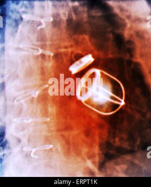 Künstlichen Herzklappen. Farbig x-ray der Brust eines 59 Jahre alten Patienten mit Herzinsuffizienz, die beide hatten, hat die Mitral- und Aortenklappe Ventile des Herzens mit künstlichen Herzklappen ersetzt. Stockfoto