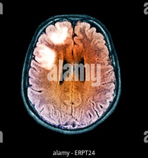 Farbige FLAIR Magnetresonanz-Bildgebung (MRI) Scan einen Schnitt durch das Gehirn eines 60 Jahre alten Patienten mit progressive multifokale Leukenzephalopathie (PML). Diese Krankheit führt zur Zerstörung von Myelin um Nerven in der weißen Substanz des Gehirns. Stockfoto