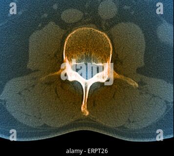 Farbige axiale Computertomographie (CT)-Scan von einem gesunden Lendenwirbel (L3) in eine 33 jährige Patientin. Die Vorderseite des Körpers ist oben. Stockfoto