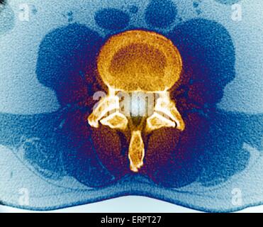 Farbige axiale Computertomographie (CT)-Scan von einem gesunden Lendenwirbel (L3) in eine 33 jährige Patientin. Die Vorderseite des Körpers ist oben. Stockfoto