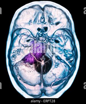 Gutartiger Hirntumor. Farbige Computertomographie (CT) Untersuchung des Gehirns eine 48 jährige Patientin mit einem Meningeom (lila). Dies ist ein gutartig (nicht krebsartige) Tumor, der aus der Hirnhaut entsteht, die Membranen, die das Gehirn umgeben. Stockfoto