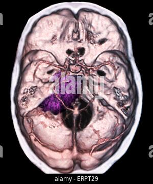 Gutartiger Hirntumor. Farbige Computertomographie (CT) Untersuchung des Gehirns eine 48 jährige Patientin mit einem Meningeom (lila). Dies ist ein gutartig (nicht krebsartige) Tumor, der aus der Hirnhaut entsteht, die Membranen, die das Gehirn umgeben. Stockfoto