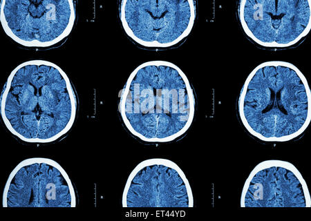 CT-Scan des Gehirns zeigen normale Gehirn (neurologische Hintergrund) Stockfoto