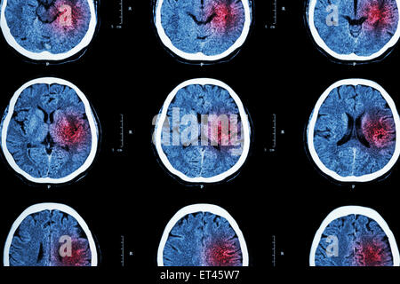 CT-Scan des Gehirns mit roten Bereich (Imaging für hämorrhagischer Schlaganfall oder ischämischen Schlaganfall (Infarkt) Konzept) Stockfoto