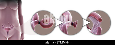 Darstellung, Tubal Verbindung des Eileiters durch Pomeroy-Methode, die einen Abschnitt des Rohres zu verhindern, dass die Befruchtung entfernt.