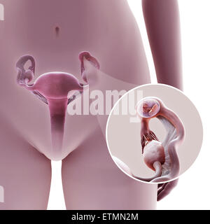 Darstellung der weiblichen Reproduktion System während einer Eileiterschwangerschaft Lage im Abschnitt Ampulle des Eileiters, zeigt ein verkleinerte Abschnitt des Embryos. Stockfoto