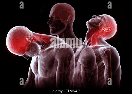 Konzeptionelle Darstellung der Phasen der Bewegung dieser Ursache Schleudertrauma: Rückzug, Erweiterung und Erholung. Stockfoto