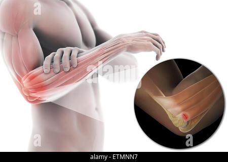 Abbildung des Armes mit transparente Haut, Verletzungen an der seitlichen Epicondylus Sehne, bekannt als laterale Epicondylitis oder Tennisarm zu zeigen. Stockfoto